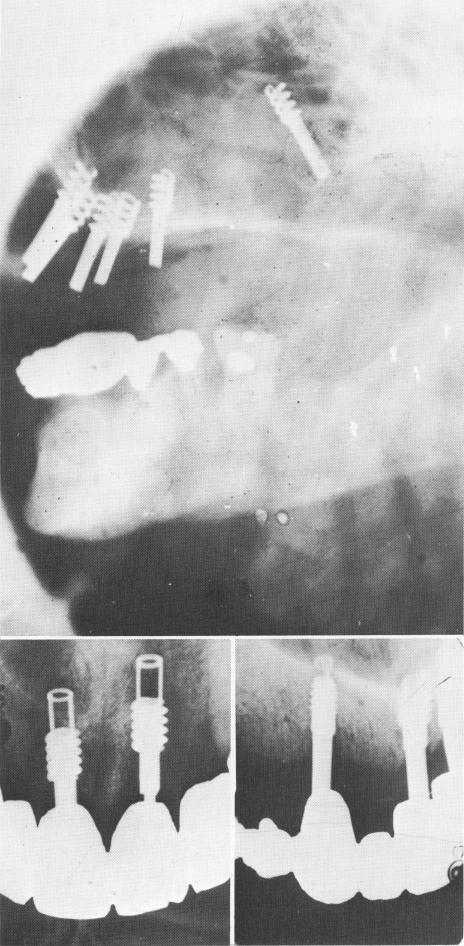 1 Chercheve type of spiral implant that was pushed into maxillary sinus