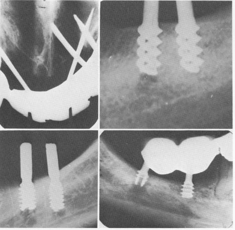2 Radiographs showing various ventplants perforating nasal vestibulum