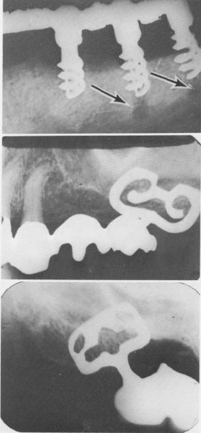 2 Implants failed because of too much resistance from jaw bone