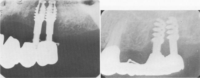 1 Dental bridge removed with all triplant pins still attached to it