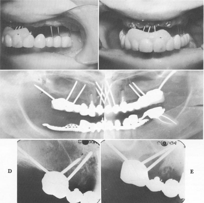 2 Panorex showing entire maxillary prosthesis & diverging pins