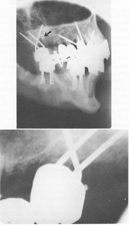 2 Maxillary bone resorption occurring where pins crossing each other