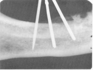 2 Pins in void, & labial & lingual cortical plates of bone still intact