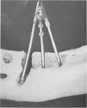 3 Dried specimen radiographed & it shows dental pins to be buried in bone