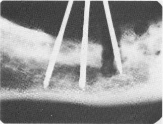 1 Mandibular bone around mesial pin revealing true picture