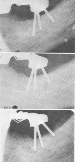 2 Serial x rays show steady bone resorption around mandibular triplant