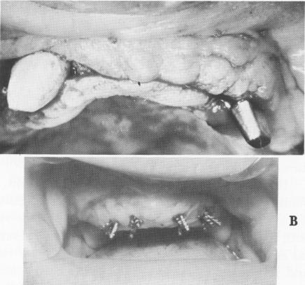 3 Acrylic core built over thin metal plate adapted to bone in maxilla