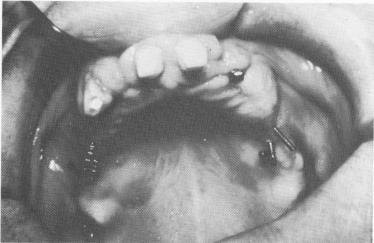 1 Longevity of triplants with out template increased in maxilla