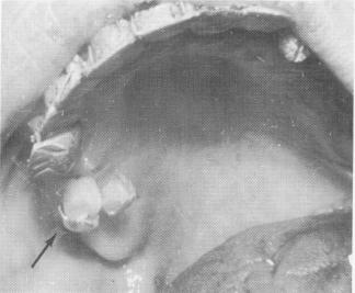 2 Aluminum shell on dental pin ends filled with cold cure acrylic opened