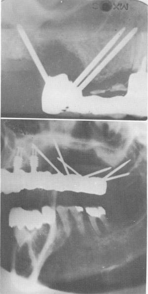 3 Triplants in maxilla failing due to very thick fibromucosal tissue 