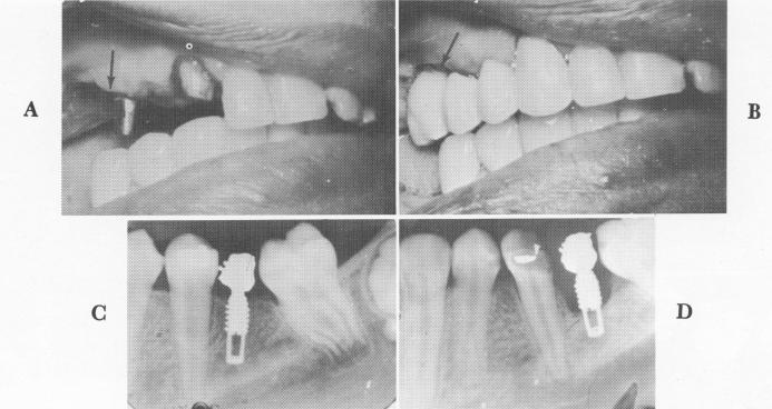 1 Dental blade implant with extra long neck is frequently preferable