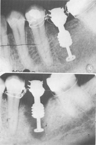 1 Single tooth implant, stabilized only by wiring to neighboring teeth