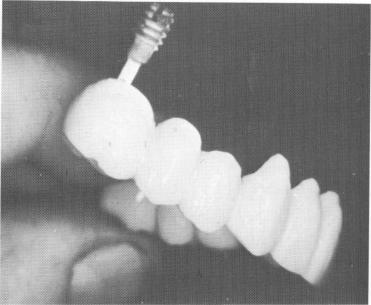 2 Cement stuck to maxillary implant post, pulling it out with splint