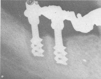3 Bone resorption around two spiral posts in mandible