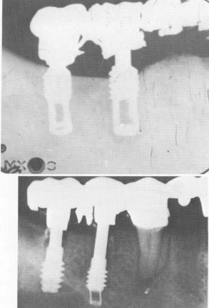 4 Overhanging margins cause food impaction leading to bone resorption