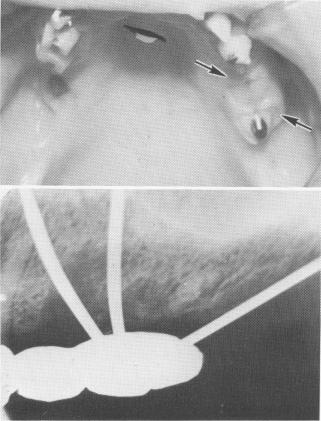 1 Tissue surrounding dental blade compressed due to poor pontic relation