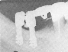 2 Triplants forced through improperly sized holes in maxillary template