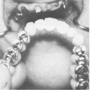 3 Broken solder joint increased load & stress on isolated dental implant 