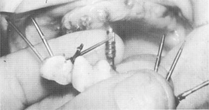 1 Cavities forming underneath crowns that support fixed dentures