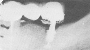 2 Cement below crowns on dental implants cause irritation of soft tissue