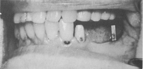 3 Poor judgment in dental restorative procedures leading to failure