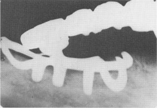 1 Intraoral x ray shows resorption below unilateral subperiosteal implant