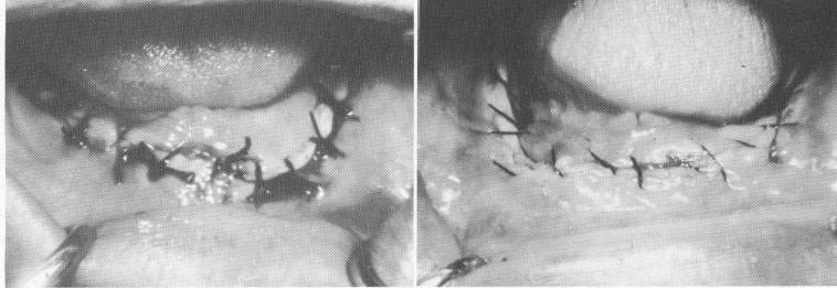 3 Sutures made too far lingually, excessively stretching buccal tissue