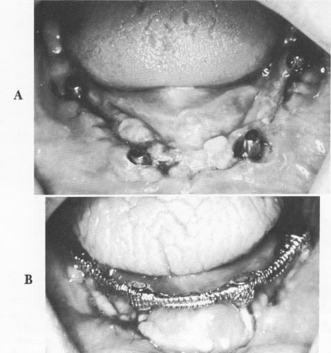2 Continuous suturing done on mandibular arch