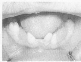 1 Peg-shaped, flared out lower teeth, implant considerations