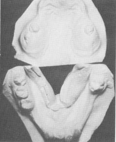 2 Upper and lower study casts of cleft palate patient, for implantation
