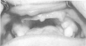 1 Clinical view of the maxilla, for implant intervention