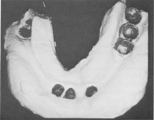 3 Plaster index of mandibular coping for implant prosthesis fabrication