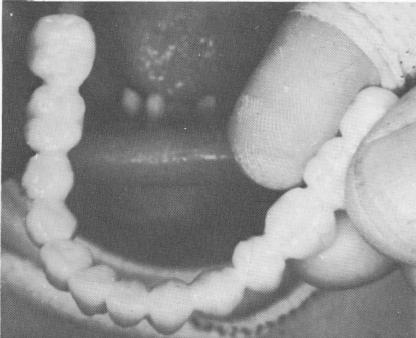 4 Lower arch porcelain-fused-to-metal implant prosthesis fabricated