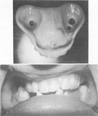 5 The upper denture implant and peg-shaped teeth of the patient