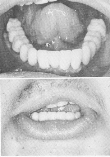 1 Incisal edge of lower implant prosthesis parallel to horizontal plane