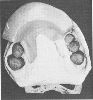 2 Duralay copings with accurate fit over prepared maxillary teeth