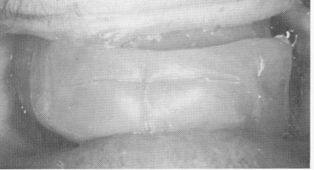 4 Wax  record of centric relation for implant prosthesis fabrication