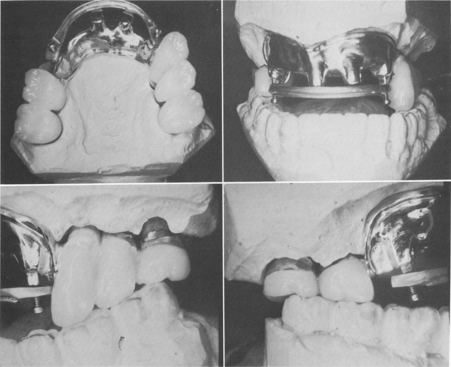 1 Anterior view shows two hollow anterior pontics to cover two implants