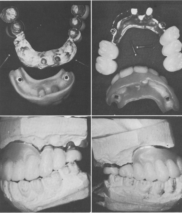 1 The bar with its two sets of internal implant threadings is waxed inside