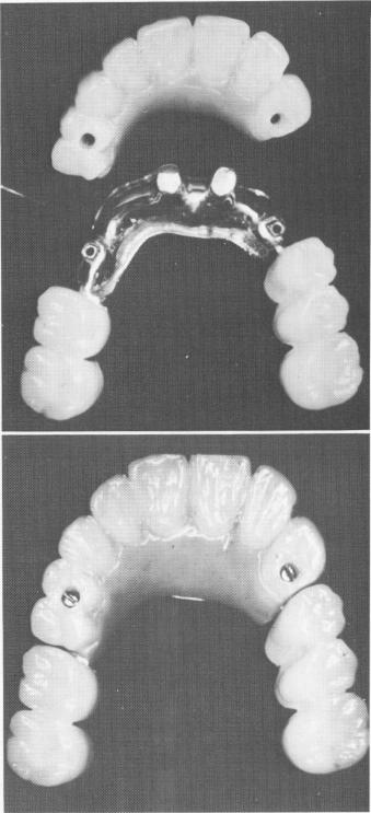 1 Implant prosthesis made for anterior quadrant with heat-cure acrylic