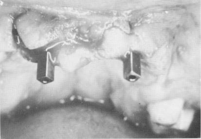 2 Narrow ridge type implants are then screwed into position in maxilla 