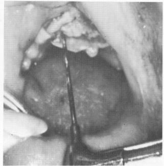 4 Incise maxillary tissue, rotate implant twist drill into narrow ridge