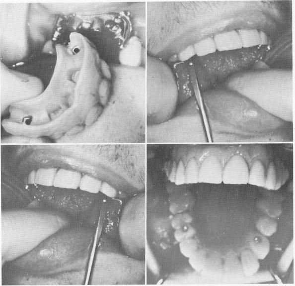 1 Anterior quadrant of teeth fitted and screwed over implant frame-work