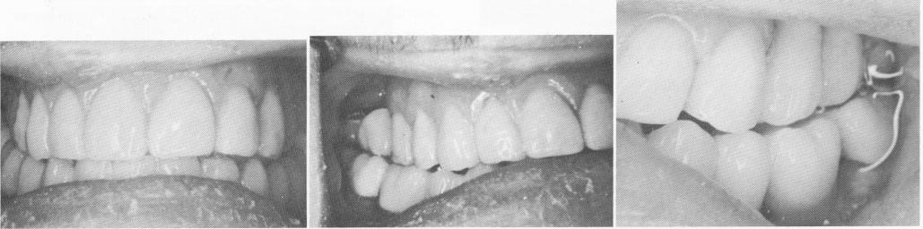 2 Completed case restoring centric occlusion with vent-plants