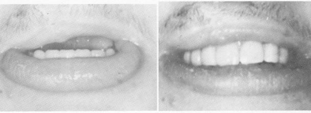 3 Upper vent plant prosthesis in position