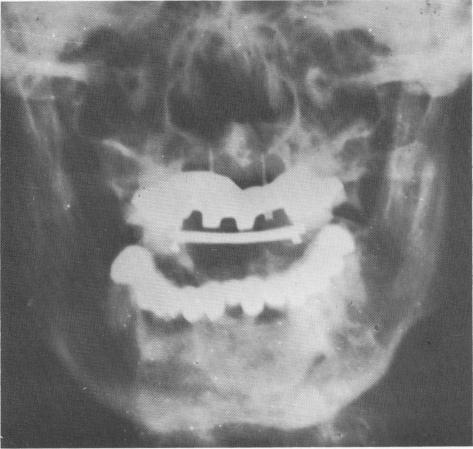 1 Posteroanterior view of maxillary narrow ridge implant, template, bar