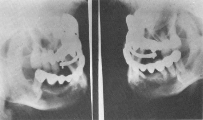 2 Lateral plate views of maxillary anterior ridge implant, template, bar