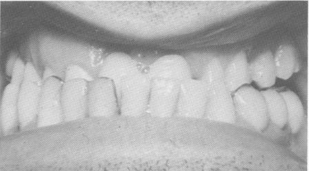 1 Class III relationship closed position before intervention