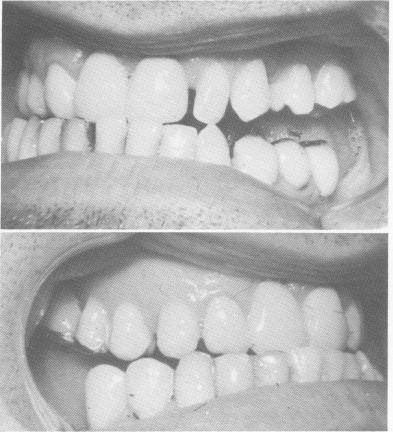 2 Incisal edges of anterior upper, lower teeth when lower jaw retruded