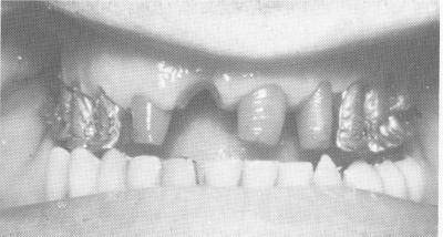 3 Upper gold crown castings, Duralay acrylic transfer copings